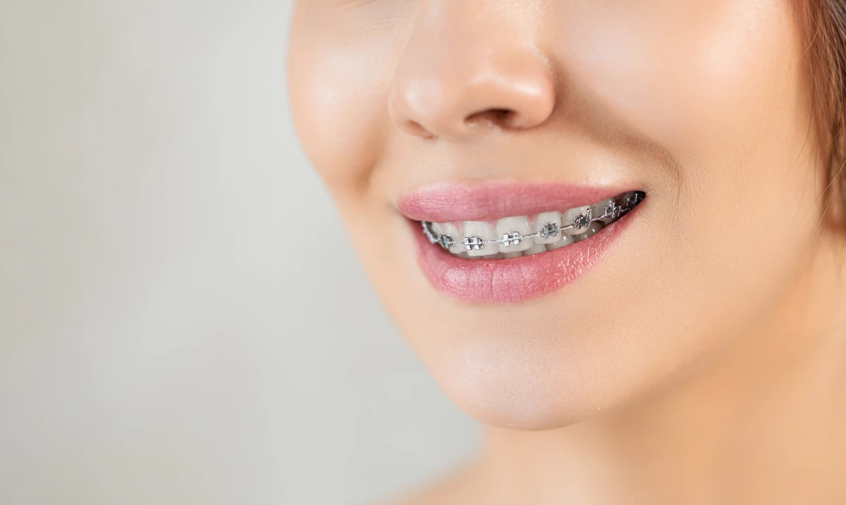 Apparecchio denti Treviso - Studio dentistico Brugnera Loriano