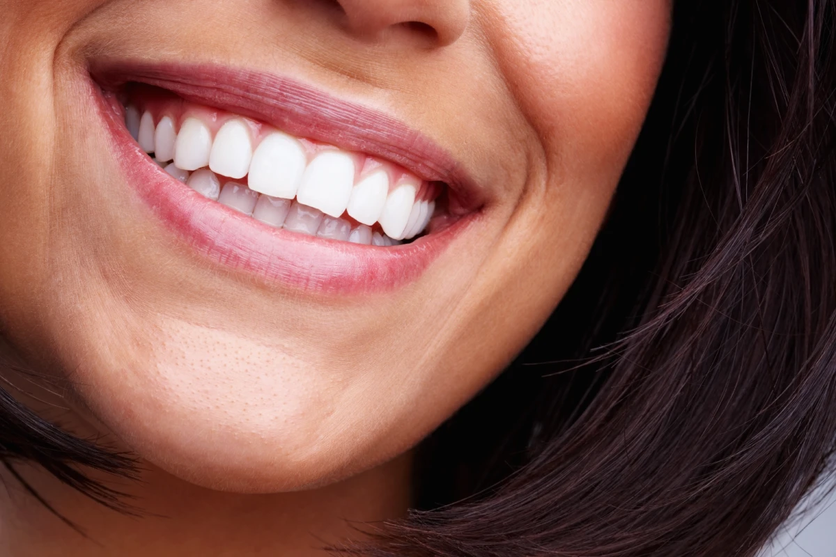 Sbiancamento denti - Studio dentistico Brugnera Loriano